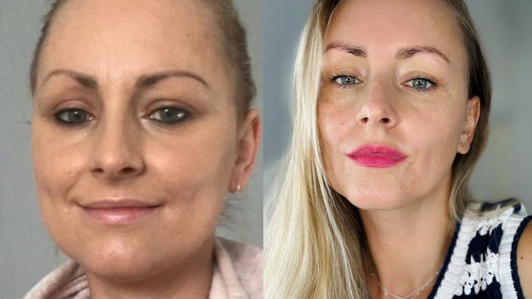NOTOX Natural Forehead Smoothing Method